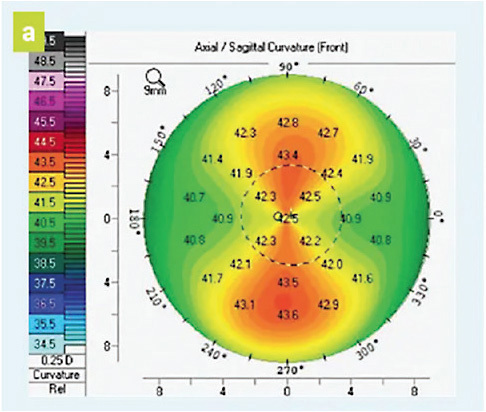 Figure 2. Shown is the scan of a patient with normal astigmatism. IMAGE COURTESY OF DIANNA E. GRAVES, COMT