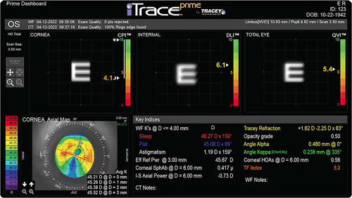 Figure: An update to the iTrace (Tracey Technologies) software, iTrace Prime Dashboard, provides an understanding of the patient’s optical system in a single display.COURTESY CORY J. PICKETT, MSN, FNP-BC, CRNO