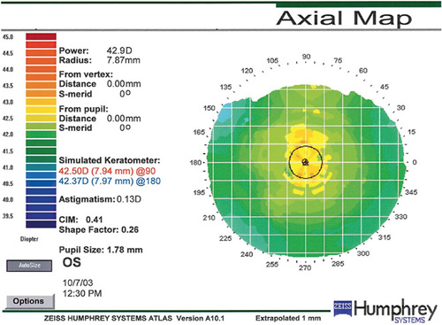 Figure 6. Axial/sagittal map provides a quick overview average of the curvature of the cornea.DEMO TRAINING AREA IMAGE FROM THE THE CARL ZEISS MEDITEC HUMPHREY ATLAS REPRINTED WITH PERMISSION