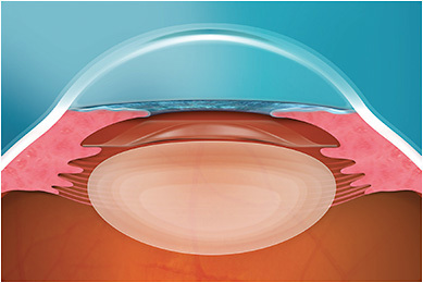 The EVO ICL is implanted within the posterior chamber of the eye directly behind the iris and in front of the natural crystalline lens. IMAGE COURTESY OF STAAR SURGICAL