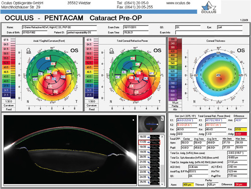 Figure 5: Shown is a cataract pre-op map, which is used to evaluate refractive status.IMAGE FROM THE DEMO TRAINING AREA OF OCULUS PENTACAM REPRINTED WITH PERMISSION